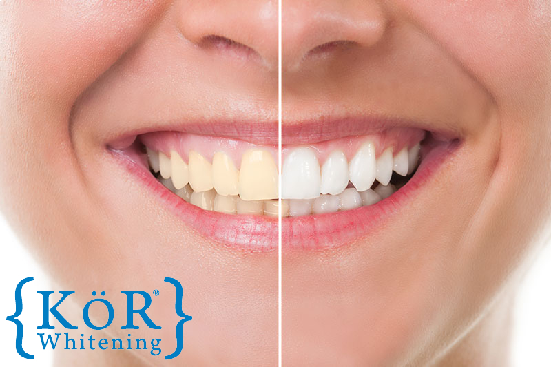 Teeth Whitening in Cypress