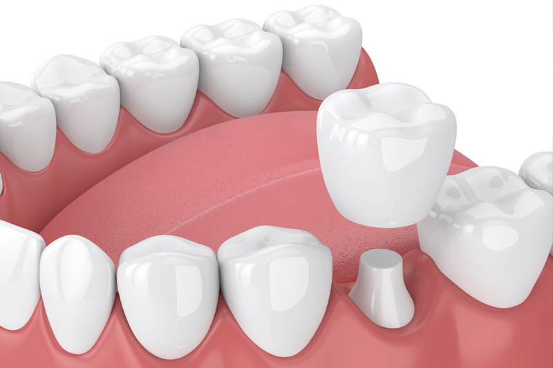 Dental Crowns in Cypress