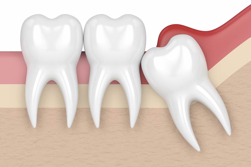 Wisdom Tooth Removal in Cypress